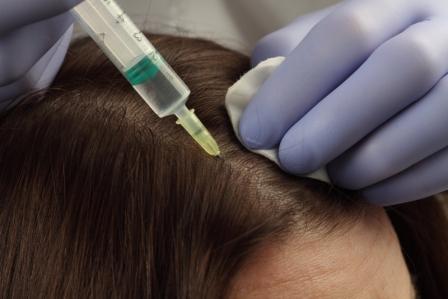Терапия волосистой части головы препаратами MesoSet