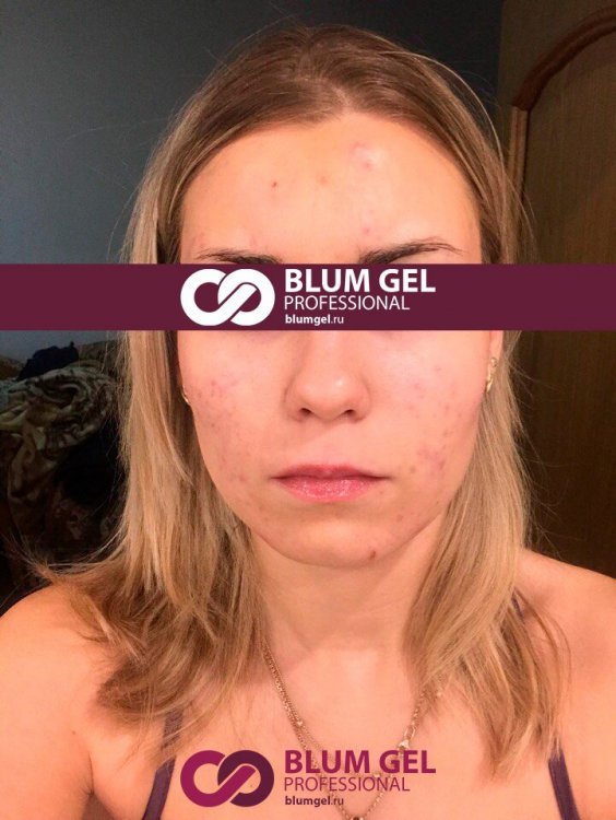 фото 1 blum gel.jpg